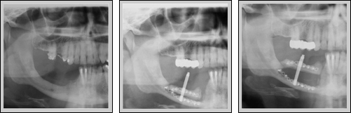 3 x-rays of the distraction osteogenesis process after resection of a tumor in the lower jaw