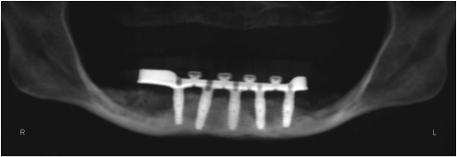 X-ray of lower jaw with dental implants with hybrid bar