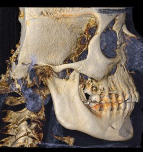 Side view of 3D imaging of a skull
