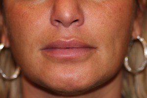 Patient's lips 8 months after Juvederm