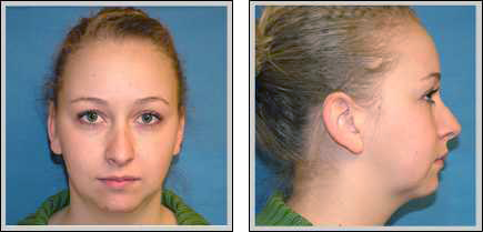 Front view and side view of after chin augmentation surgery