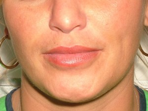 Patient's lips 1 month after Juvederm