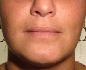 Patient's lips before Juvederm