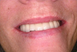 smile with new dental implants