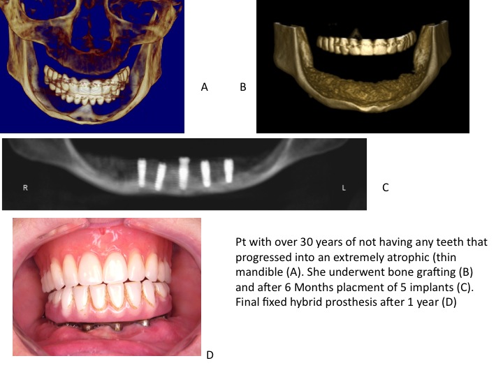 a) 3D image of jaw before bone grafting, b) 3D image of a jaw after bone grafting, c) 5 dental implants placed in the jaw, d) dentures and dental implants in the mouth