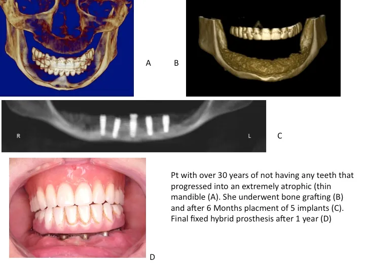 a) 3D image of jaw before bone grafting, b) 3D image of a jaw after bone grafting, c) 5 dental implants placed in the jaw, d) dentures and dental implants in the mouth