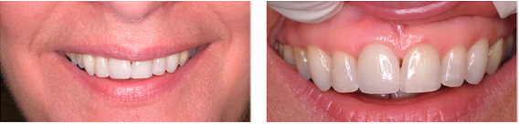 Before and after picture of Dental Implants