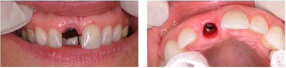Up view and front view of a single upper tooth implant