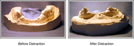 Distraction Osteogenesis Springboro OH, Bone Regeneration