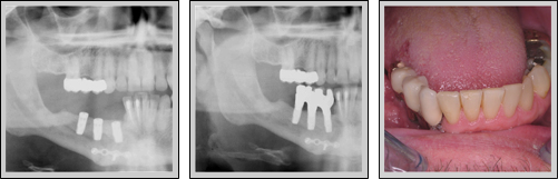 2 x-rays and a final photo of hte distraction osteogeneis process after resection of a tumor in the lower jaw