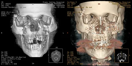 X-ray of facial trauma fractures and 3D image of facial trauma fractures