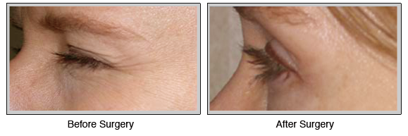 Botox before and after photos