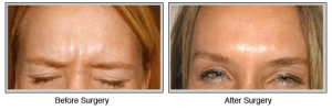 Botox before and after photos