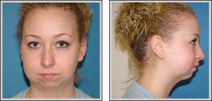 Front view and side view of before chin augmentation surgery