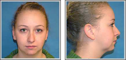 Front view and side view of after chin augmentation surgery