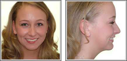 Front view and side view of after chin implant