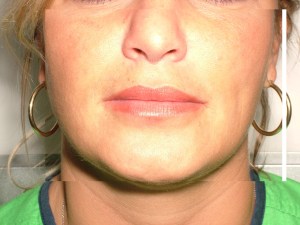 Lips after lip filler