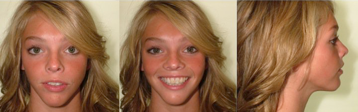 after jaw surgery