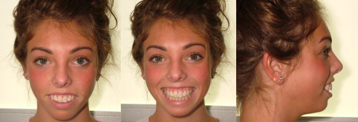 Before jaw surgery