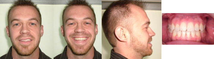 jaw surgery after