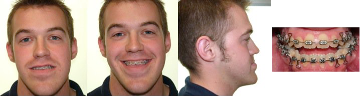 jaw surgery before
