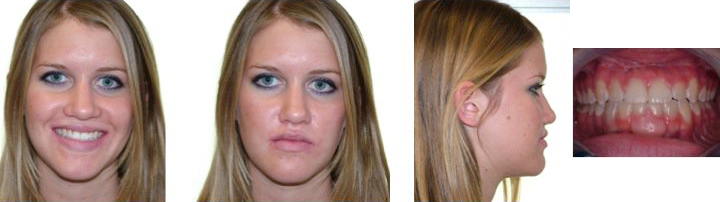 after jaw surgery