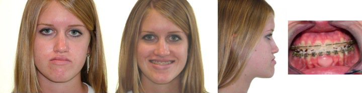 before jaw surgery
