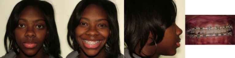 after jaw surgery