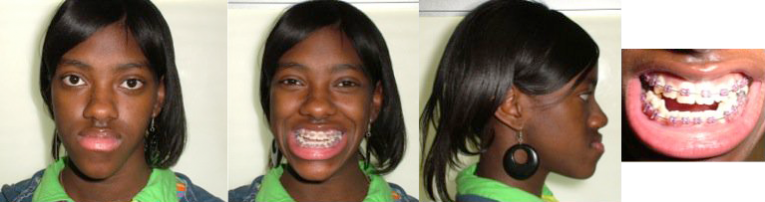 before jaw surgery
