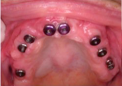 implants in gumline