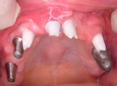 implants in gumline