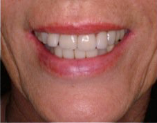 smile before dental implants