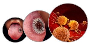 Oral cancer image