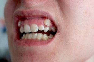 Impacted Canine Teeth